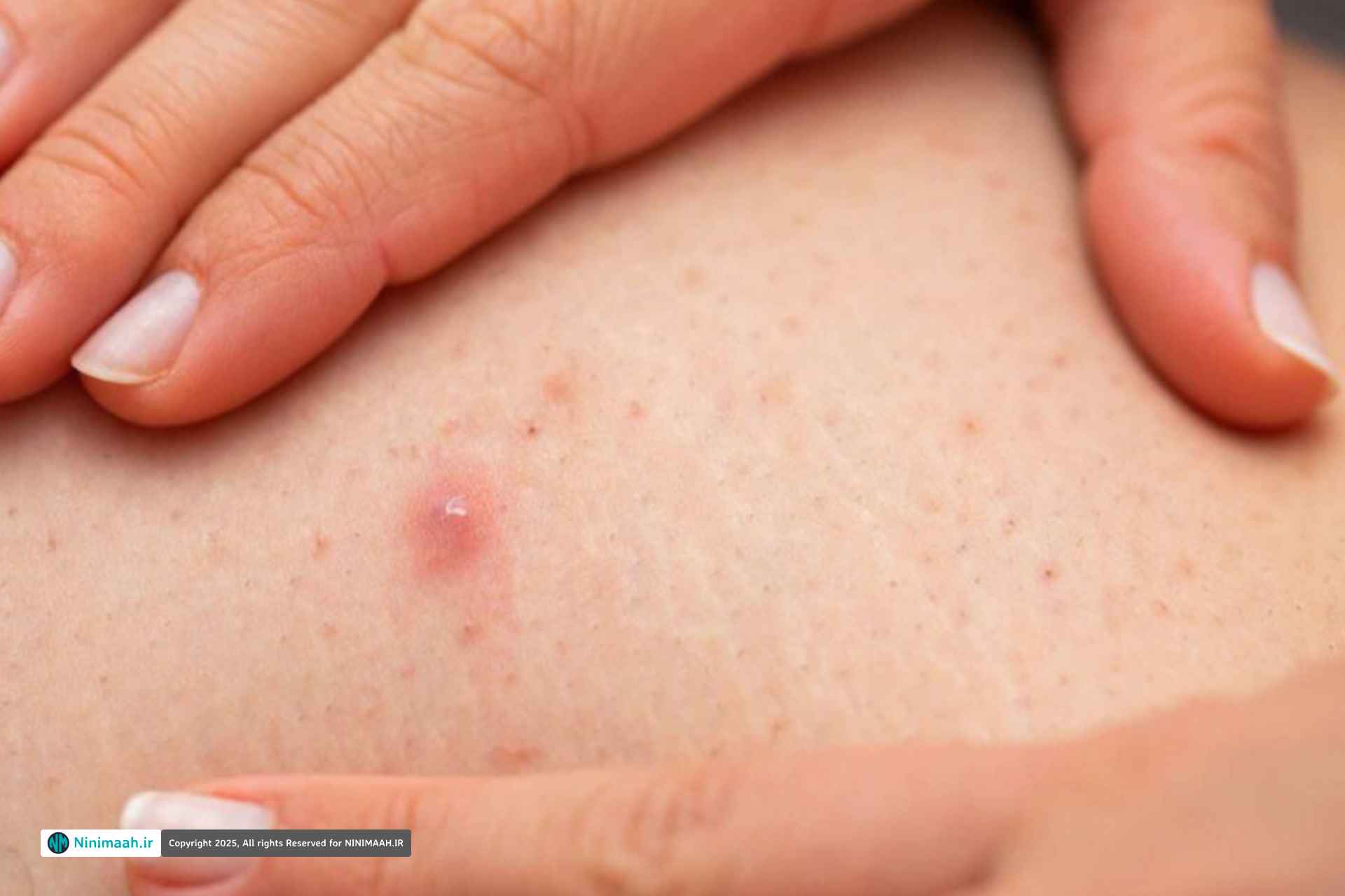 راهکارهای درمانی برای فولیکولیت