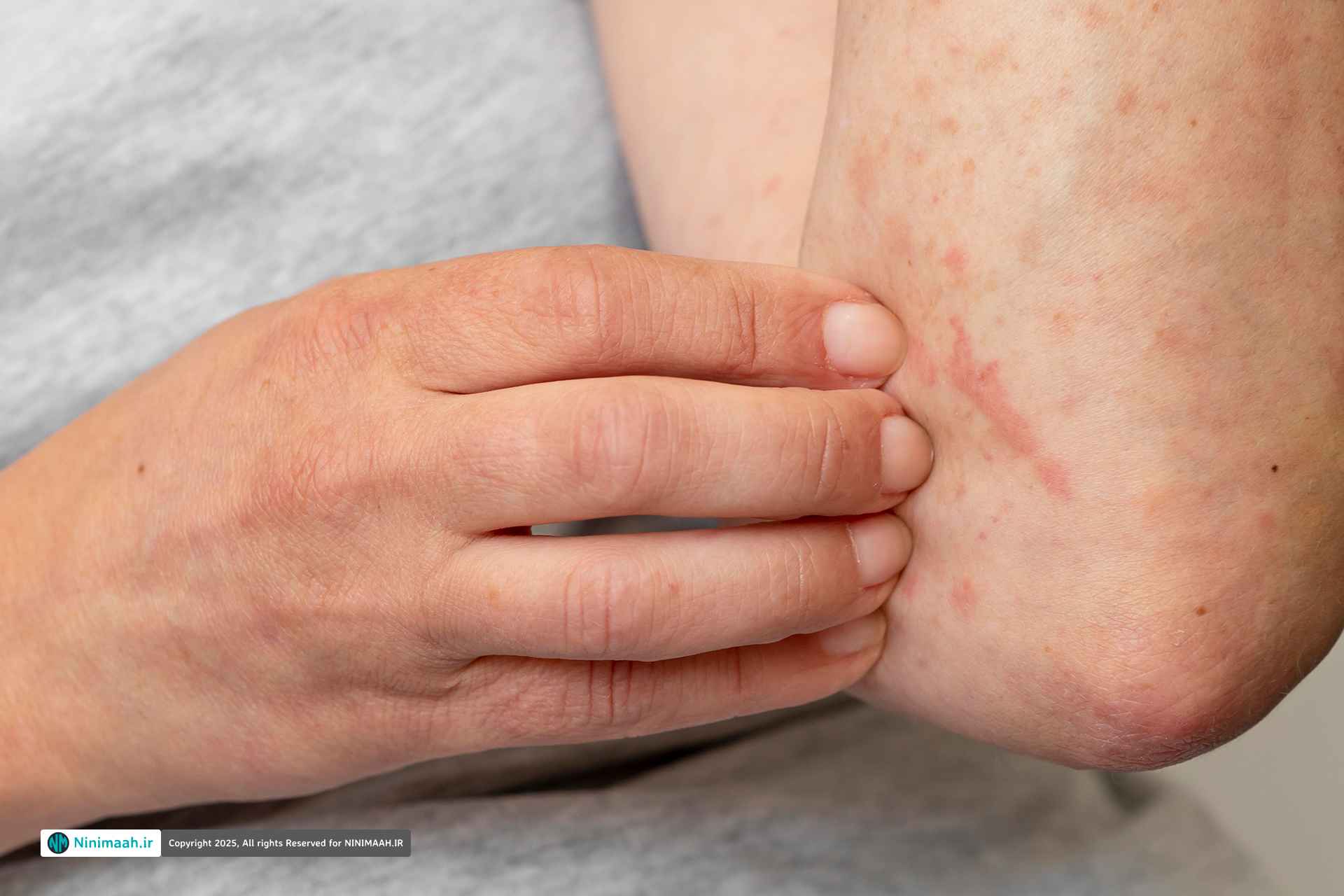 درمان سریع کهیر | بهترین قرص ها و روش های قطعی رفع خارش و التهاب