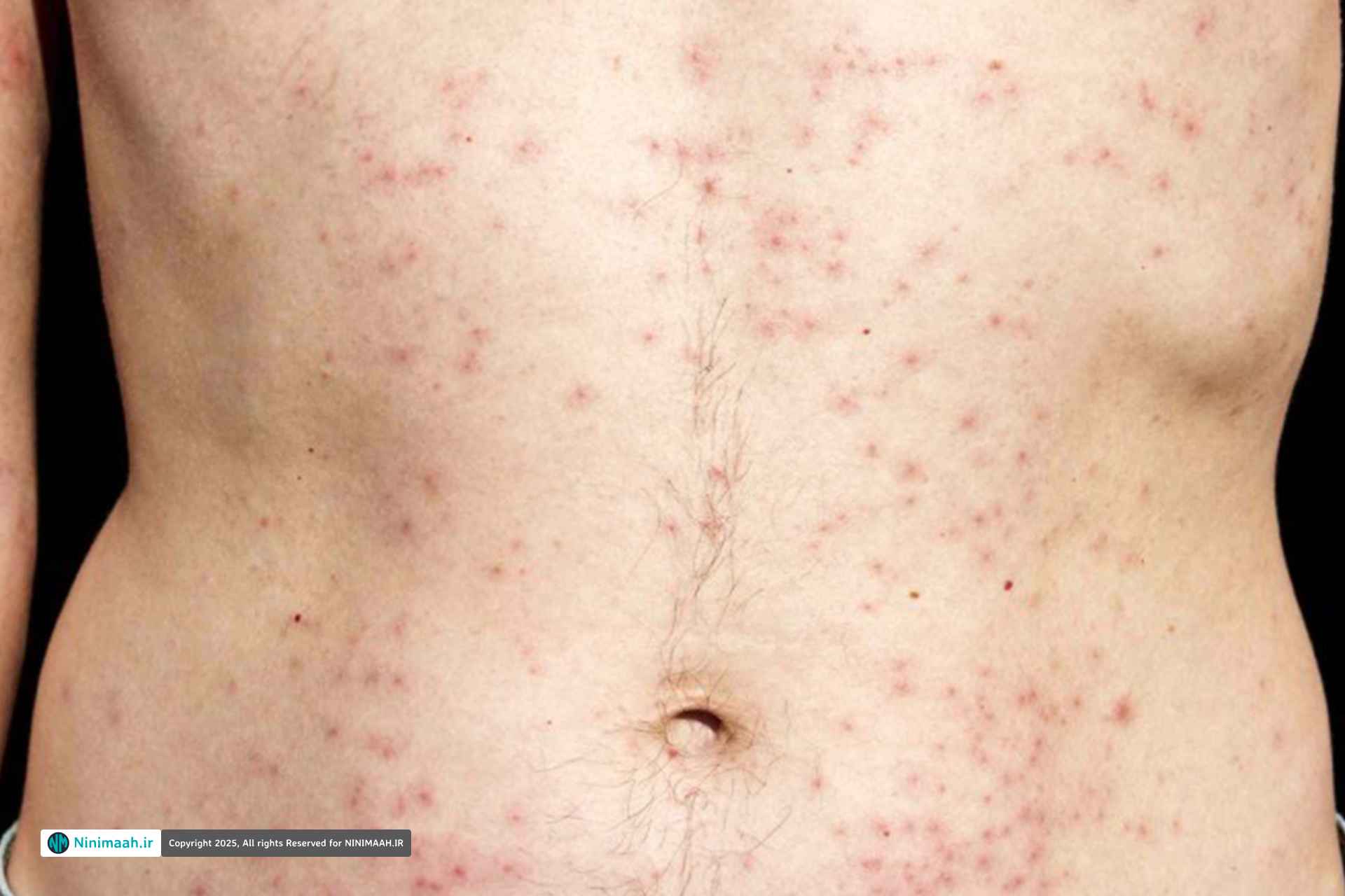 راهکارهای خانگی برای درمان فولیکولیت خفیف