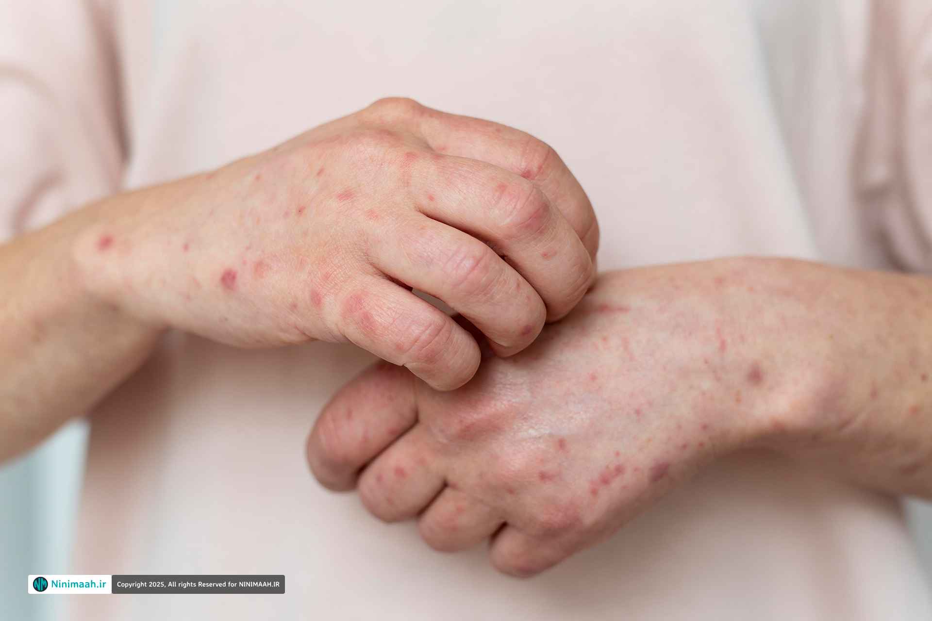 درمان سریع کهیر | بهترین قرص ها و روش های قطعی رفع خارش و التهاب