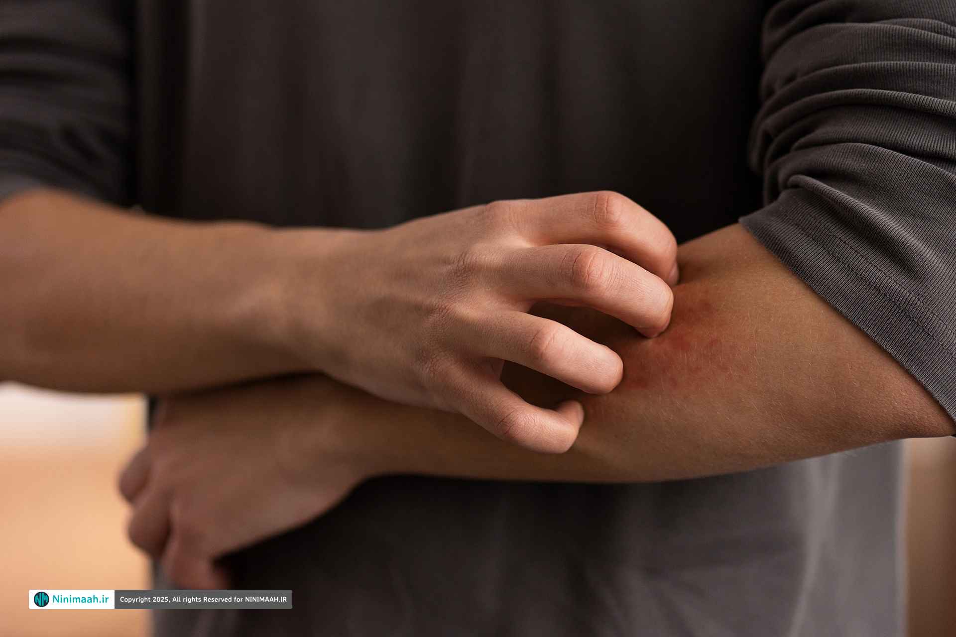 درمان سریع کهیر | بهترین قرص ها و روش های قطعی رفع خارش و التهاب