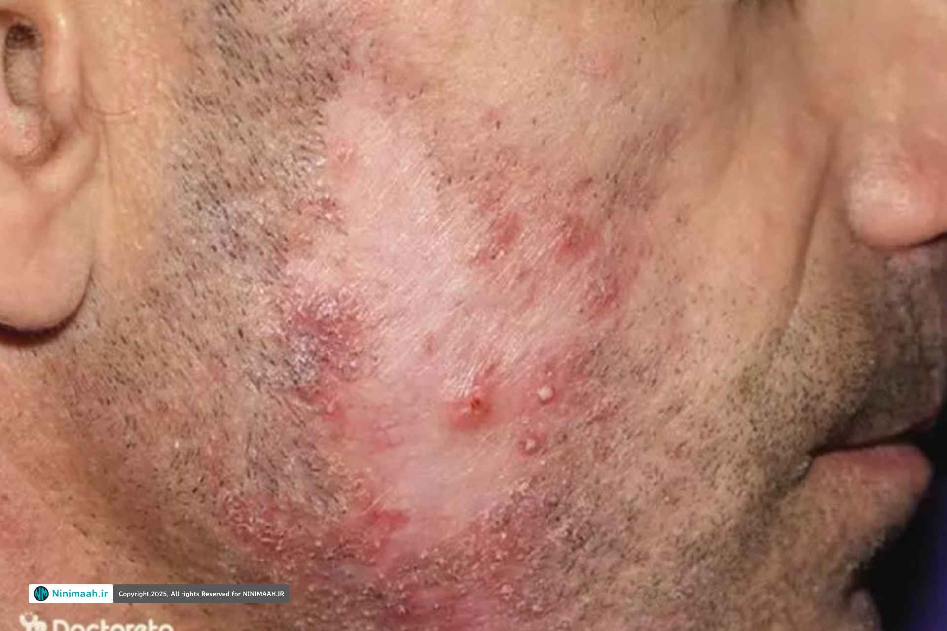 علائم بالینی فولیکولیت مو