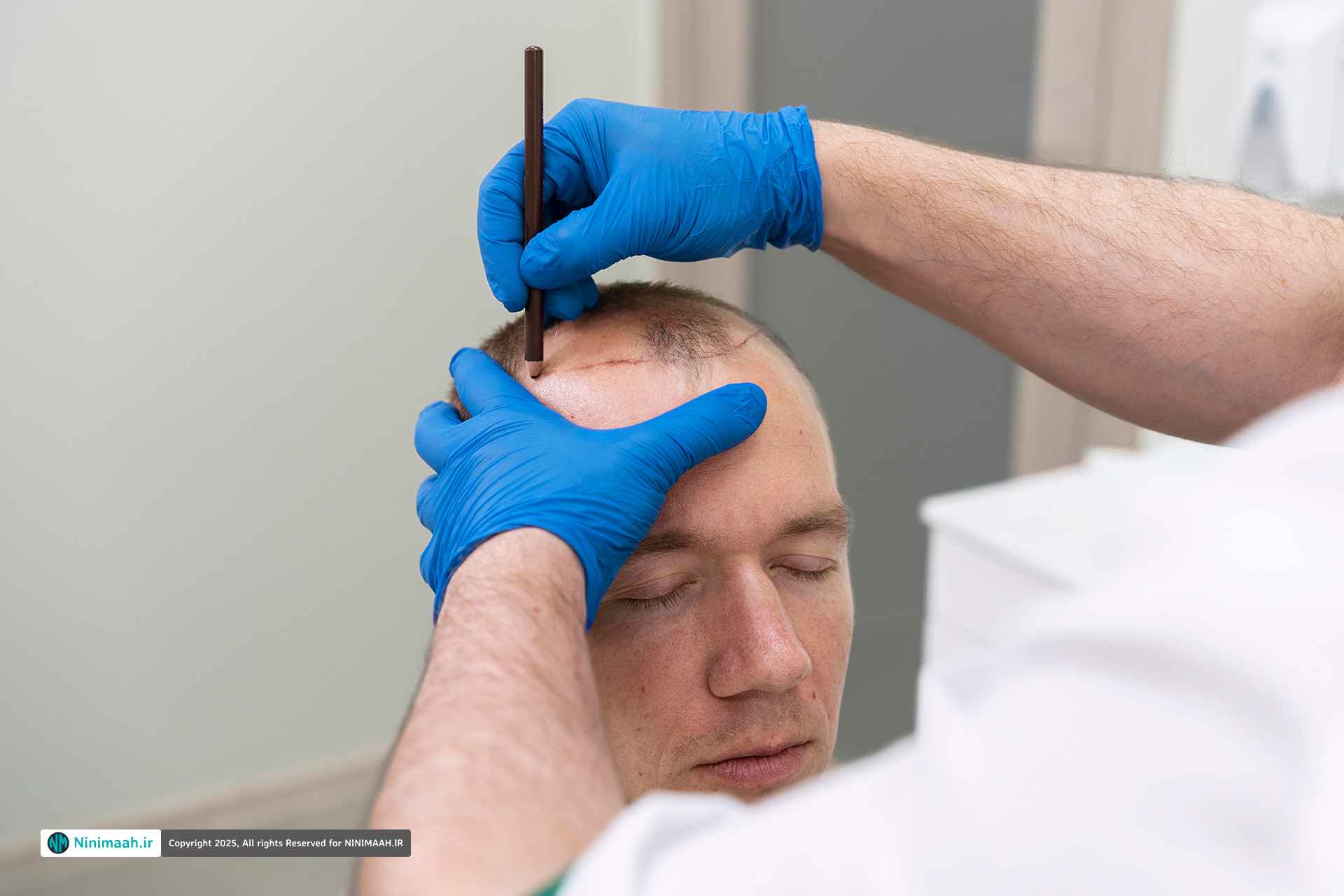 کاشت مو به روش FUT | روشی پر کاربرد برای درمان طاسی سر