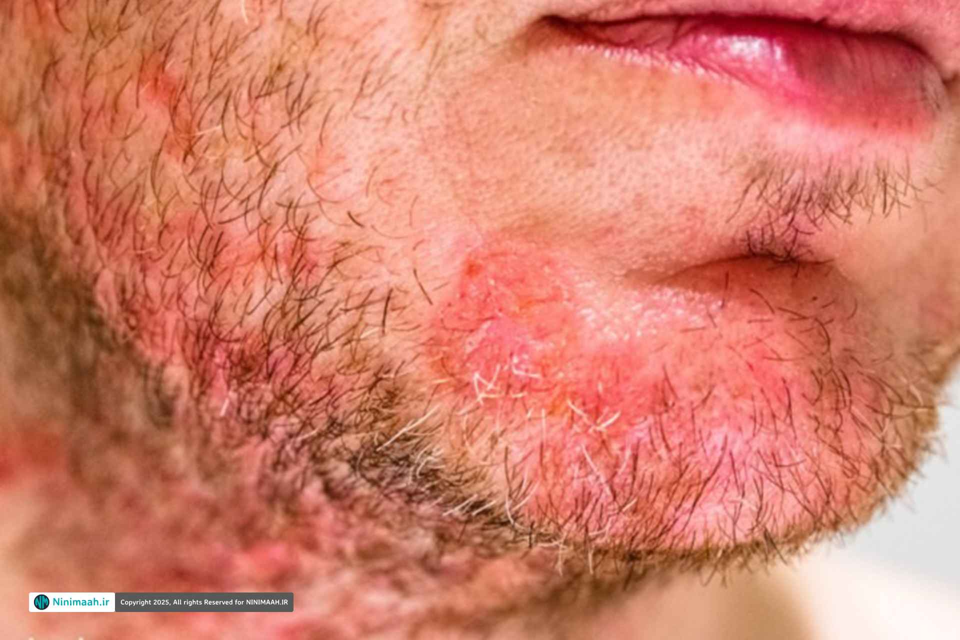 دلایل التهاب فولیکول مو (فولیکولیت)