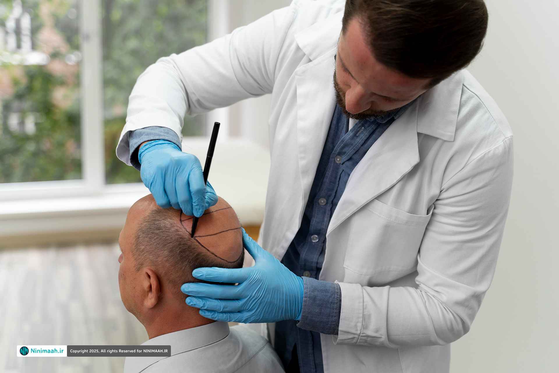 کاربردها و مزایای روش کاشت مو FUE